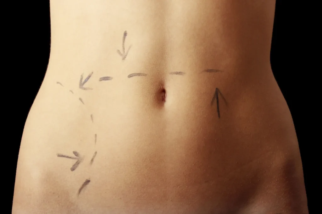 Close-up of a bare abdomen with surgical markings and arrows.