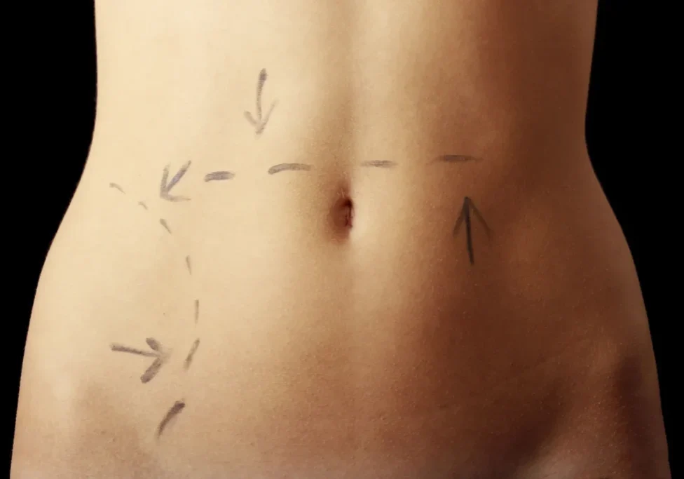 Close-up of a bare abdomen with surgical markings and arrows.